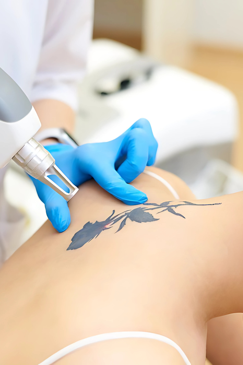 Tattoo Removal